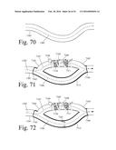 Implanted Extracardiac Device for Circulatory Assistance diagram and image