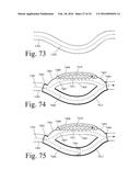 Implanted Extracardiac Device for Circulatory Assistance diagram and image