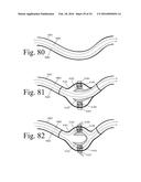 Implanted Extracardiac Device for Circulatory Assistance diagram and image