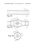 Implanted Extracardiac Device for Circulatory Assistance diagram and image