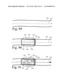 Implanted Extracardiac Device for Circulatory Assistance diagram and image