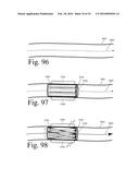 Implanted Extracardiac Device for Circulatory Assistance diagram and image