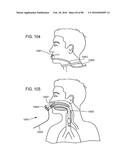 METHODS, SYSTEMS AND DEVICES FOR NON-INVASIVE OPEN VENTILATION WITH GAS     DELIVERY NOZZLES WITH AN OUTER TUBE diagram and image