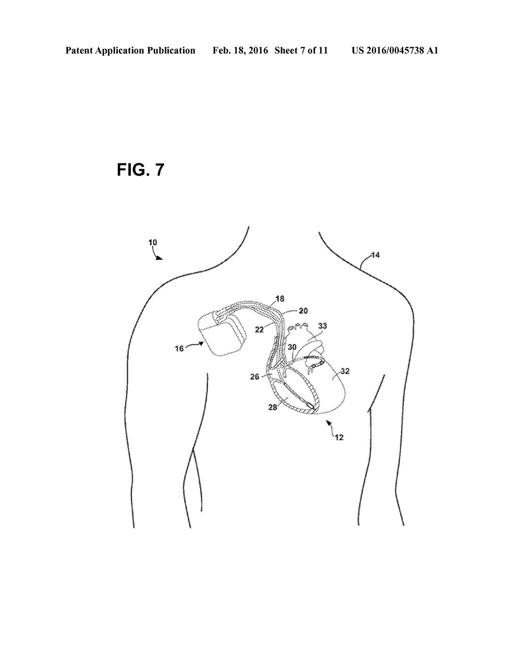 SYSTEMS AND METHODS FOR CONFIGURATION OF ATRIOVENTRICULAR INTERVAL - diagram, schematic, and image 08