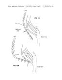 Integrated Electromyographic Clinician Programmer for Use with an     Implantable Neurostimulator diagram and image