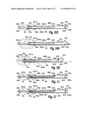 BALLOON CATHETER diagram and image