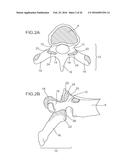 METHODS AND APPARATUS FOR STABILIZING BONE diagram and image