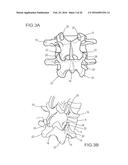 METHODS AND APPARATUS FOR STABILIZING BONE diagram and image