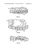 SYSTEMS AND METHODS FOR FABRICATING A DENTAL TEMPLATE diagram and image