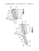 Vertebral Implants and Related Methods of Use diagram and image