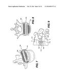 Vertebral Implants and Related Methods of Use diagram and image