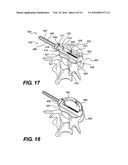 Vertebral Implants and Related Methods of Use diagram and image