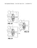 Vertebral Implants and Related Methods of Use diagram and image