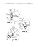 Vertebral Implants and Related Methods of Use diagram and image