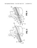 Vertebral Implants and Related Methods of Use diagram and image