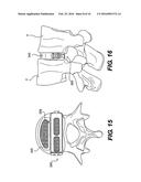 Vertebral Implants and Related Methods of Use diagram and image
