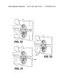 Vertebral Implants and Related Methods of Use diagram and image