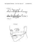 SLEEP APNEA DEVICE TO POSITIVELY BLOCK EXHALING AND METHOD OF USE diagram and image