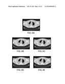 ITERATIVE RECONSTRUCTION FOR X-RAY COMPUTED TOMOGRAPHY USING PRIOR-IMAGE     INDUCED NONLOCAL REGULARIZATION diagram and image