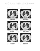 ITERATIVE RECONSTRUCTION FOR X-RAY COMPUTED TOMOGRAPHY USING PRIOR-IMAGE     INDUCED NONLOCAL REGULARIZATION diagram and image