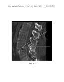 Polymer Osteosynthesis/Translaminar Screw for Surgical Spine Treatment diagram and image