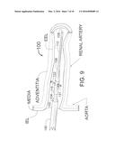 METHOD FOR PAINLESS RENAL DENERVATION USING A PERI-VASCULAR TISSUE     ABLATION CATHETER WITH SUPPORT STRUCTURES diagram and image