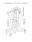 METHOD FOR PAINLESS RENAL DENERVATION USING A PERI-VASCULAR TISSUE     ABLATION CATHETER WITH SUPPORT STRUCTURES diagram and image