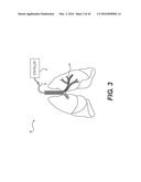 DEVICES FOR DAMAGING NERVES AND RELATED METHODS OF USE diagram and image