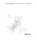 DEVICES FOR DAMAGING NERVES AND RELATED METHODS OF USE diagram and image