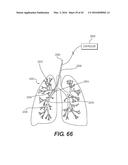 DEVICES FOR DAMAGING NERVES AND RELATED METHODS OF USE diagram and image