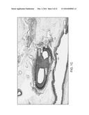 METHODS FOR MODULATING RENAL NERVE TISSUE AND ASSOCIATED SYSTEMS AND     DEVICES diagram and image