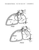 FILTER APPARATUS FOR OSTIUM OF LEFT ATRIAL APPENDAGE diagram and image