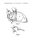 FILTER APPARATUS FOR OSTIUM OF LEFT ATRIAL APPENDAGE diagram and image