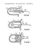 FILTER APPARATUS FOR OSTIUM OF LEFT ATRIAL APPENDAGE diagram and image