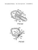 FILTER APPARATUS FOR OSTIUM OF LEFT ATRIAL APPENDAGE diagram and image