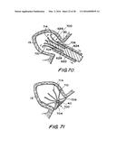 FILTER APPARATUS FOR OSTIUM OF LEFT ATRIAL APPENDAGE diagram and image