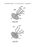 FILTER APPARATUS FOR OSTIUM OF LEFT ATRIAL APPENDAGE diagram and image