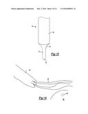 KNOTLESS GRAFT FIXATION ASSEMBLY diagram and image