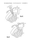 KNOTLESS GRAFT FIXATION ASSEMBLY diagram and image