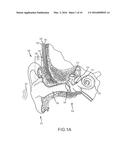 SUSPENDED COMPONENTS IN AUDITORY PROSTHESES diagram and image