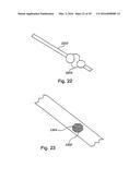 INTRAVASCULAR ANEURYSM TREATMENT DEVICE AND METHODS diagram and image