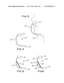 Sleep Apnea Prevention diagram and image