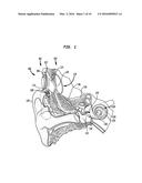 INTRA-COCHLEAR STIMULATING ASSEMBLY INSERTION diagram and image