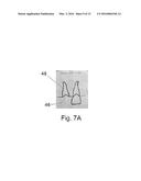 System and Method for Customized Anatomical Implant Prosthetic Pieces diagram and image