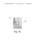 System and Method for Customized Anatomical Implant Prosthetic Pieces diagram and image