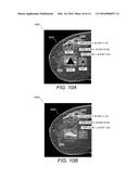 Displaying Computer-Aided Detection Information With Associated Breast     Tomosynthesis Image Information diagram and image