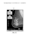 Displaying Computer-Aided Detection Information With Associated Breast     Tomosynthesis Image Information diagram and image