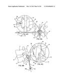 SYSTEMS AND METHODS FOR POSTERIOR DYNAMIC STABILIZATION OF THE SPINE diagram and image