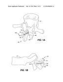 DEVICE AND METHOD FOR CORRECTING A SPINAL DEFORMITY diagram and image