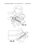 DEVICE AND METHOD FOR CORRECTING A SPINAL DEFORMITY diagram and image